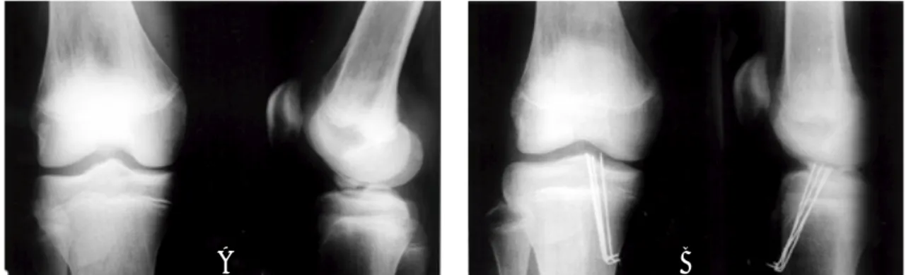 Fig 3A. 16 year old boy sustained Type III tibial intercondylar eminence fracture.