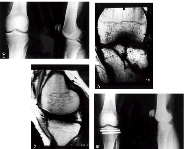 Fig 2B. Coronal MR image shows associated with tibial plateau fracture Fig 2C. Sagittal MR image shows tear of medial meniscus posterior horn Fig 2D