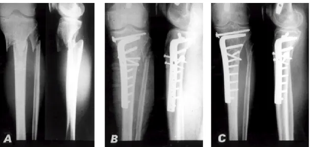 Fig 1B. Postoperative radiographs show that undisplaced articular fracture was fixed with a 6.5 mm cancellous screw and multifragmentary metaphyseal fracture was reduced directly and fixed with the lag screws and the 95°condylar blade plate.