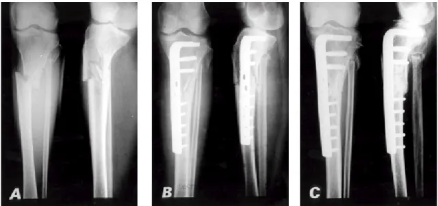 Fig 2A. Initial radiographs show AO type A3 fracture of the left proximal tibia in a 73-year-old woman.