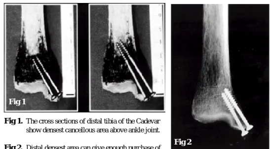 Fig 2. Distal densest area can give enough purchase of the 40mm length screw threads. 