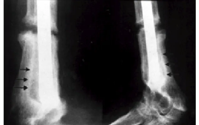 Fig 2. Several sclerotic lines around the nail are seen(arrow). It was supposed to indicate  side-to-side instability