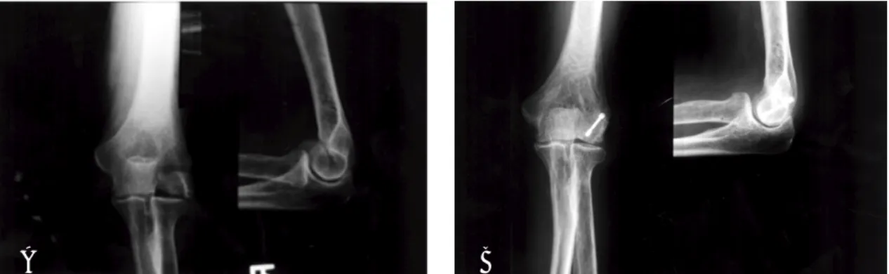 Fig 1A-B. Anteroposterior and lateral radiographs of the right elbow. (A) The initial radiograph