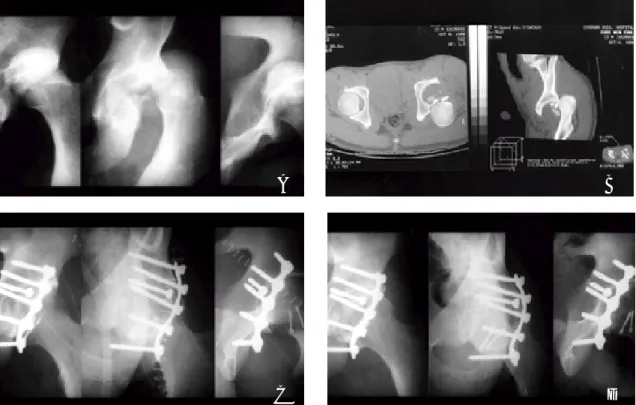 Fig 1A. Posterior wall fracture and posterior hip dislocation in a 21-year-old male