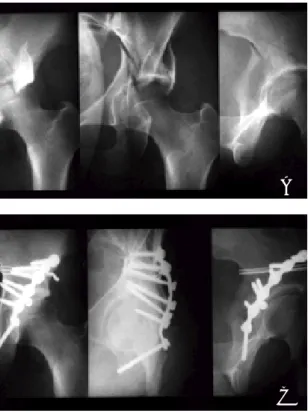 Fig 2B. Postoperative radiographs show wire anchorage at the AIIS and the greater sciatic notch and plate fixation on retroacetabular space 