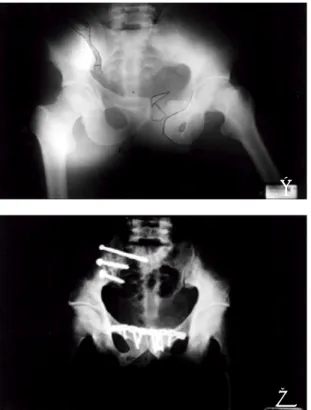 Fig 2B. Immediate post-operation. Anatomical reduction was done.