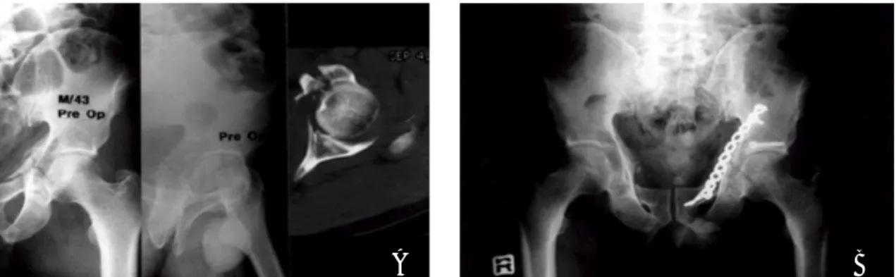 Fig 1. 43-year-old patient with transverse fracture of the acetabulum (A) Preoperative &amp; (B) Postoperative radiograph 