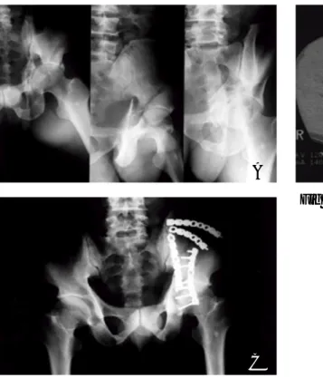 Fig 2.  40-year-old patient with both column fracture of the acetabulum (A),(B) Preoperative radiograph and CT, (C) Postoperative radiograph