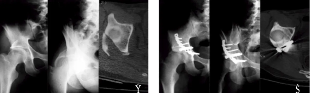Fig 3. 19-year-old patient with posterior wall fracture of the acetabulum (A) Preoperative &amp; (B) Postoperative radiograph and CT 