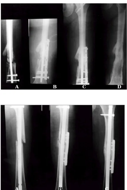 Fig 3B.  Augmentative plate fixation was applied to the fracture site and simultaneous bone grafting was performed