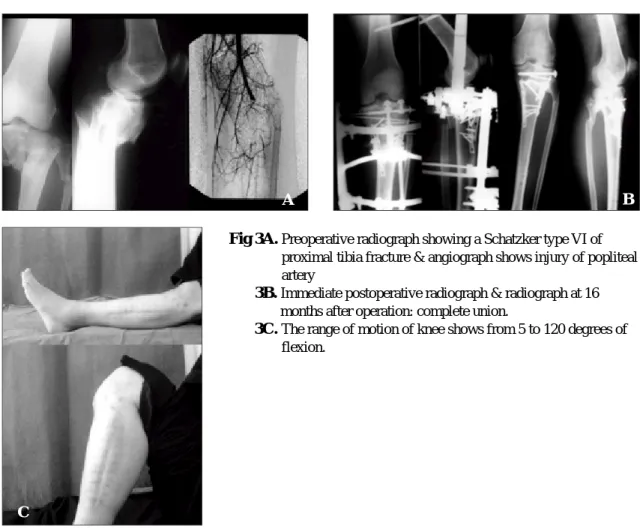 Fig 3B.  Immediate postoperative radiograph &amp; radiograph at 16 months after operation: complete union.
