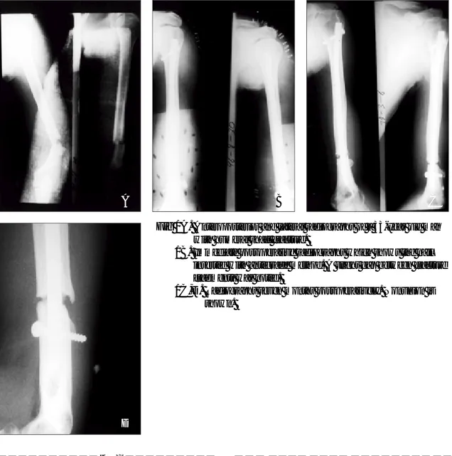 Fig 1B.  Immediate postoperative radiographs which shows the nail inserted with antegrade method