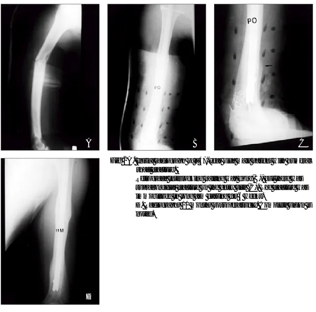 Fig 1B.  Retrograde interlocking nailing was done(B), but there was supracondylar fracture on the entry site (C)