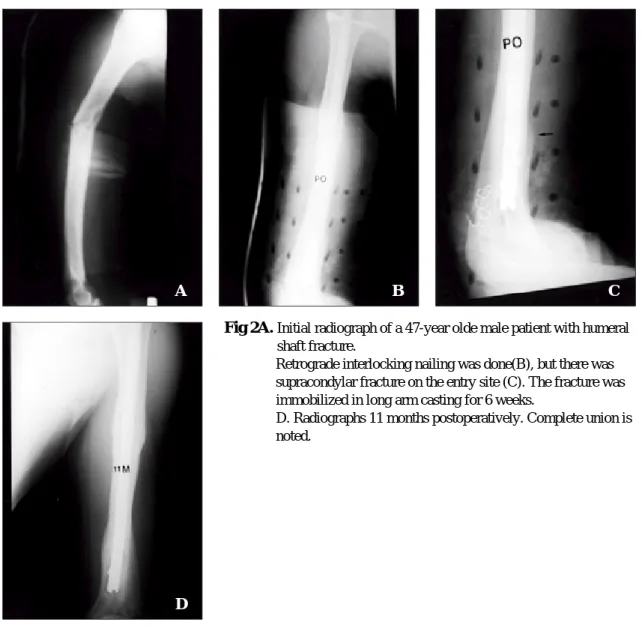 Fig 1B.  Retrograde interlocking nailing was done(B), but there was supracondylar fracture on the entry site (C)
