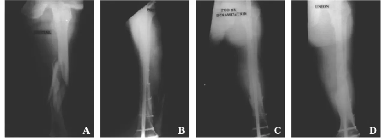 Fig 1.  Serial radiographs of 37 year-old male patient treated with open interlocking intramedullary nailing