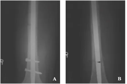 Fig 1. There was a closing of the fracture gap with telescoping of the nail after dynamization.