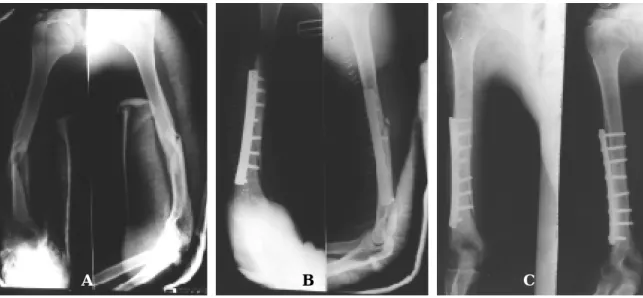 Table 8. Postoperative complication.