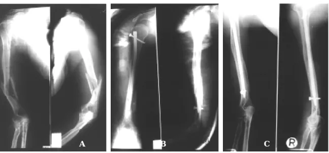 Fig 2-B.  Closed reduction and internal fixation with closed interlocking nail Fig 2-C