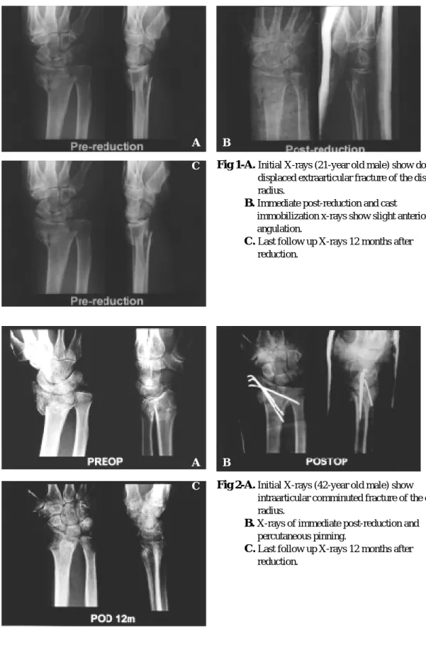 Fig 1-A.  Initial X-rays (21-year old male) show dorsally displaced extraarticular fracture of the distal radius.