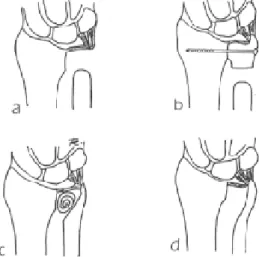 Fig 1. Schematic of the various operative procedures for the distorted distal radioulnar joint ; (A) Darrach, (B) Sauve-Kapandji arthrodesis, (C) Bowers’hemiresection interposition