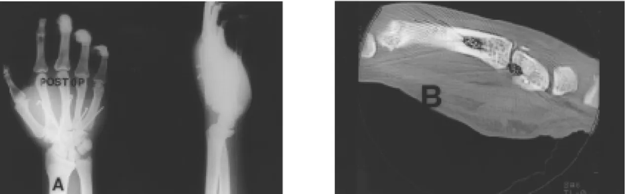 Fig. 1-B. Initial CT scan showing dorsal dislocation of carpometacarpal joints excluding thumb