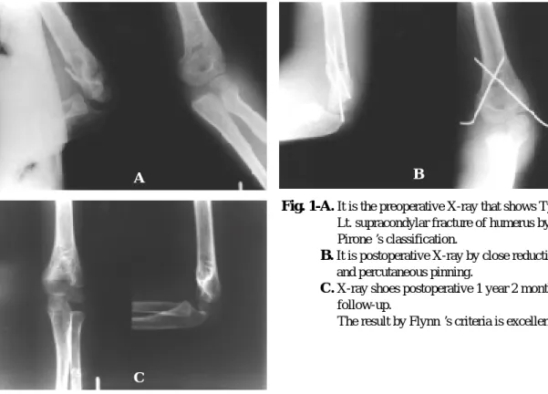 Fig. 1-A. It is the preoperative X-ray that shows Type II Lt. supracondylar fracture of humerus by Pirone’s classification