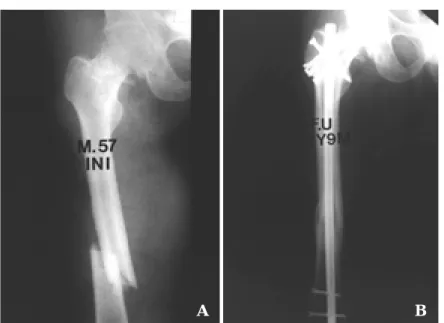 Fig 1-A. Initial X-ray of 57 years old male patient showed the comminuted fracture of the femoral shaft (Winquist Hansen type