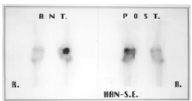 Fig 3. Whole body bone scan shows uptake on right patella abnormal hot.