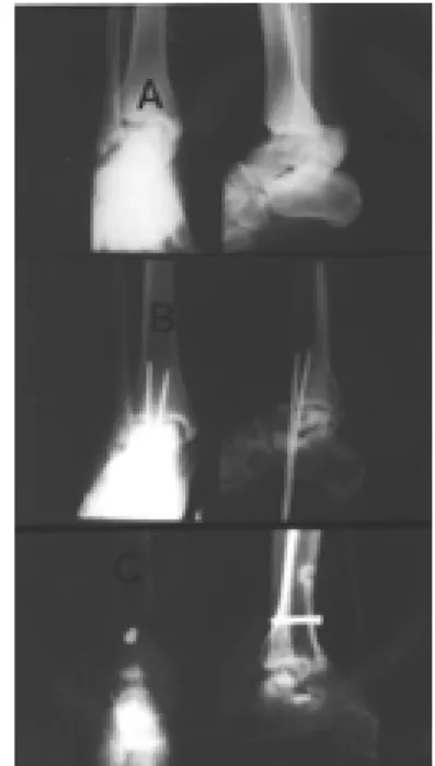Fig 1-B. Infected talar body removed and antibiotics mixed cement bead inserted.