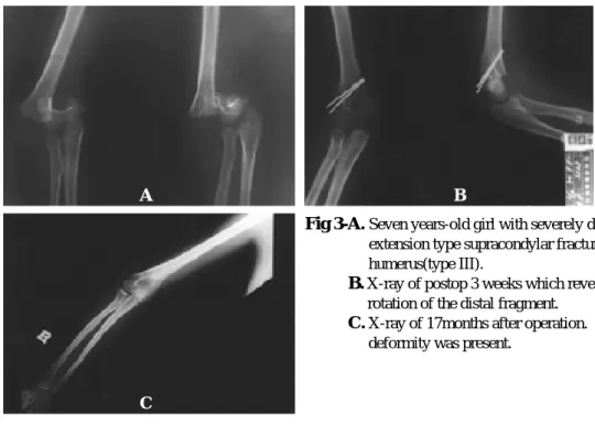 Fig 3-A. Seven years-old girl with severely displaced extension type supracondylar fracture of the right humerus(type III).