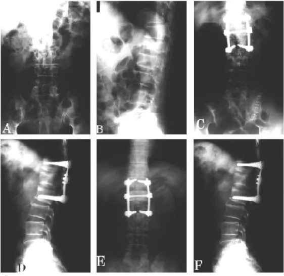 Fig 1-A,B. Preoperative plain X-ray showing L1 bursting fracture with 24°of kyphotic angle and 40% of intial loss of anterior vertebral height
