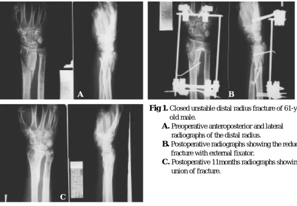 Fig 1. Closed unstable distal radius fracture of 61-year- 61-year-old male.