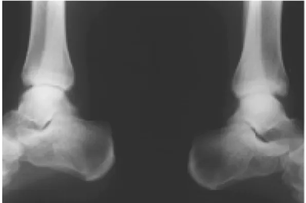 Fig 5. At postoperative 3 months, both ankle lateral roentgenogram show bony union without displacement.