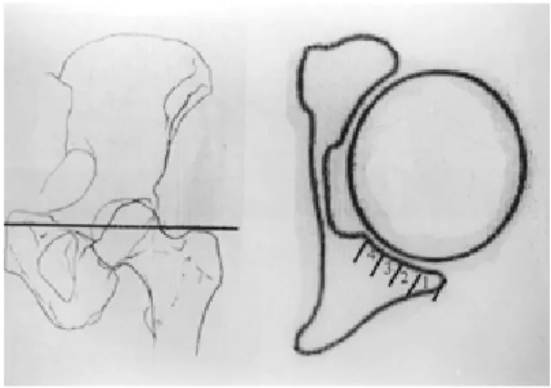 Table 1.  Frequency of acetabular posterior wall fractures