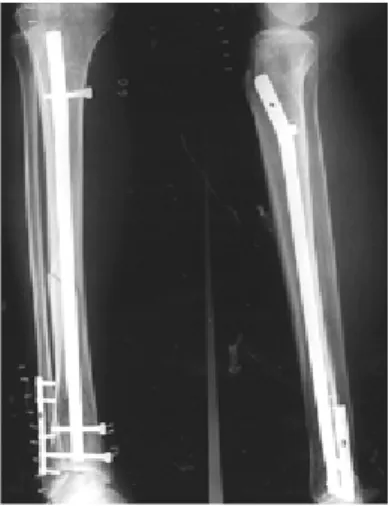 Fig 2. Postoperative anteroposterior X-ray : End of the intramedullary nail was cut before insertion.