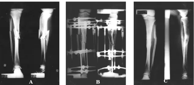 Fig 2-A. Preoperative radiograph shows segmental comminuted tibial shaft fracture.