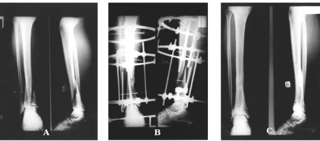 Fig 3-A. Preoperative radiograph shows intra-articular comminuted distal tibial fracture and distal fibular shaft fracture.