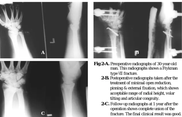 Fig 2-A. Preoperative radiographs of 30-year-old man. This radiographs shows a Frykman type Ⅷ fracture.