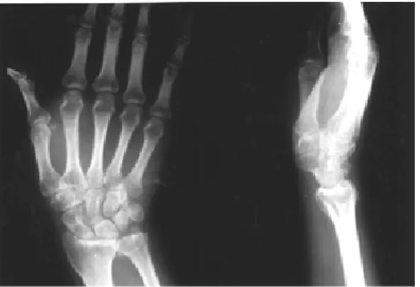 Fig 4. One year follow-up radiograph shows degenerative change of distal radio-ulnar joint