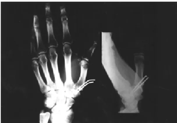 Fig 1. Initial X-ray shows simultaneous dislocation of the metacarpophalangeal and