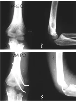 Fig A.  Preoperative x-ray showed Milch type II lateral condyle fracture with minimal displacement of fragment of fracture