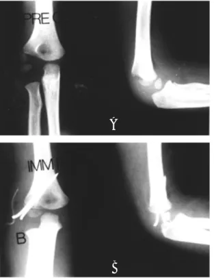Fig A.  Preoperative x-ray showed Milch type II lateral condyle fracture with displacement beyond 2mm of fragment of fracture but, articular congruency was maintained by cartilaginous hinge