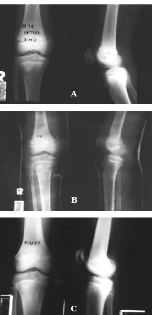 Fig 1-B. Postoperative reontgenogram with closed reduction and cast shows no anatomical reduction.