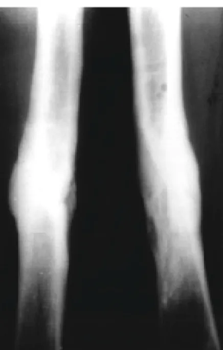 Fig 2. At 1 month after open reduction and internal fixation with plate, bone cement containing antibiotics were inserted due to infection.