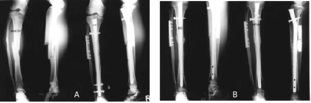 Fig  A. Initial &amp; Postoperative radiographs show left tibia segmental fracture (Melis Type III) which was fixed with intramedullary nail and additionally, the proximal fracture was fixed with two cortical screws for prevention of later displacement.