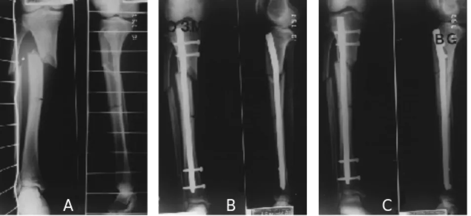 Fig 3-A. X-ray at the postop. 3 months of comminuted fracture of distal tibia fixed intramedullary nail.