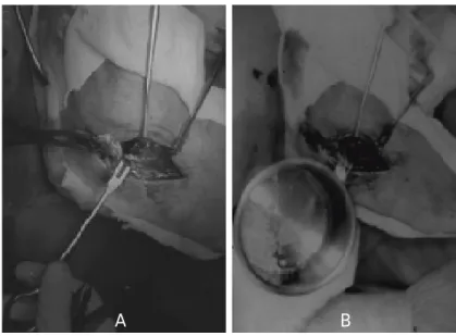 Fig 1-A.  Using a lateral approach, the subtalar joint was exposed.