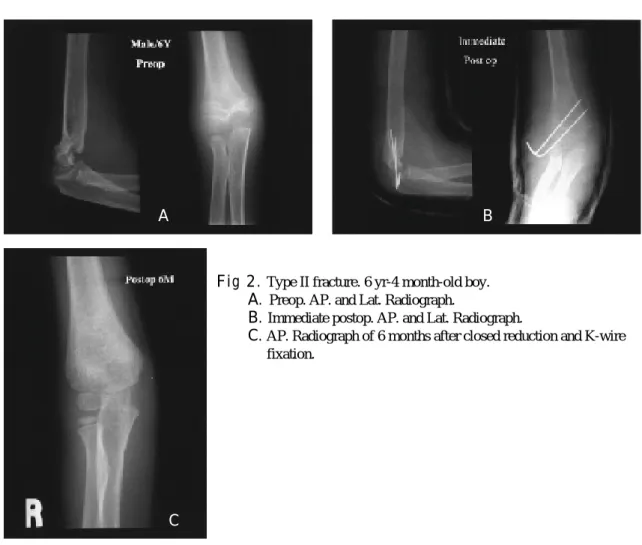 Fig  A. Preop. AP. and Lat. Radiograph.