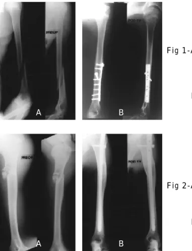 Fig 1- B. Radiograph 1 year after operation, demonstrating bone union with plate and screw fixation.