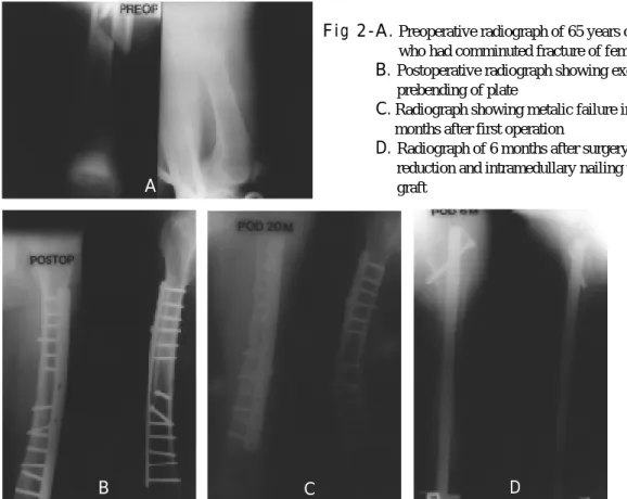 Fig 2- C. Radiograph showing metalic failure in 20 months after first operation